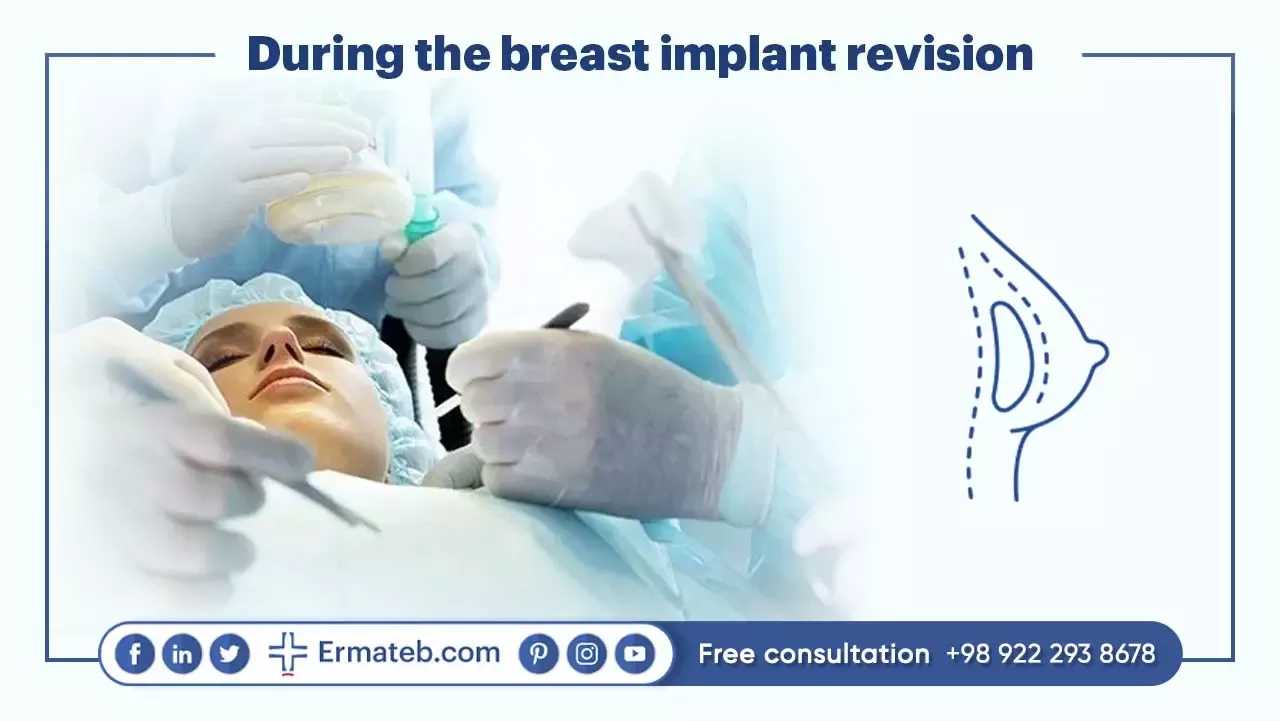 During the breast implant revision