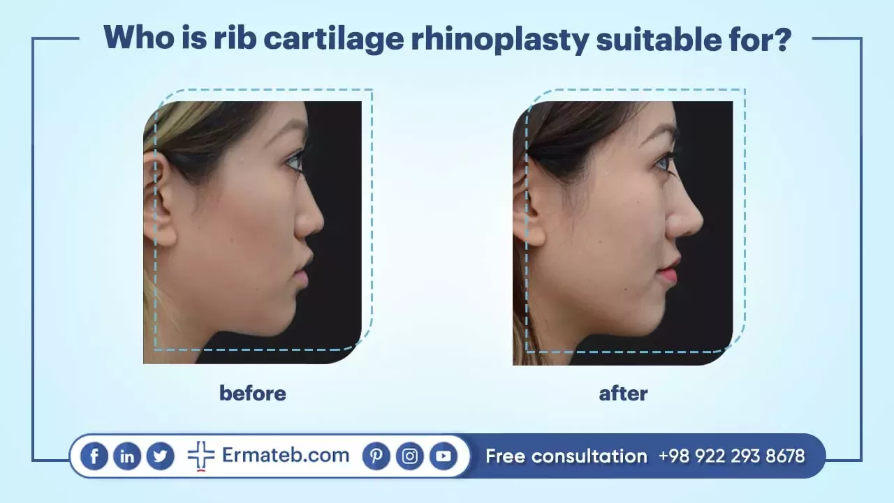 Who is rib cartilage rhinoplasty suitable for?