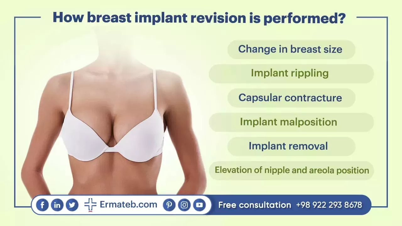 How breast implant revision is performed?