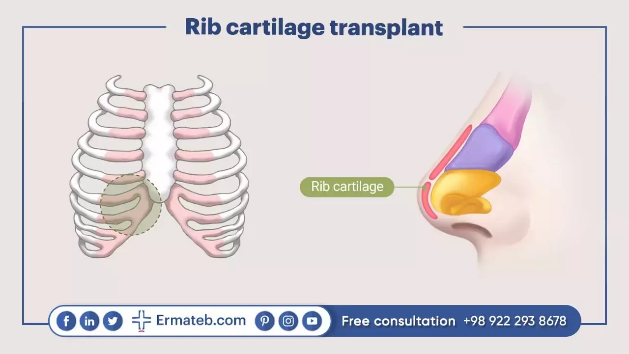 Rib cartilage transplant