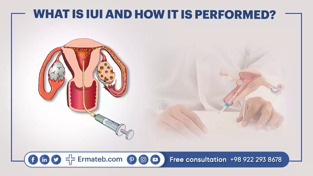 WHAT IS IUI AND HOW IT IS PERFORMED?