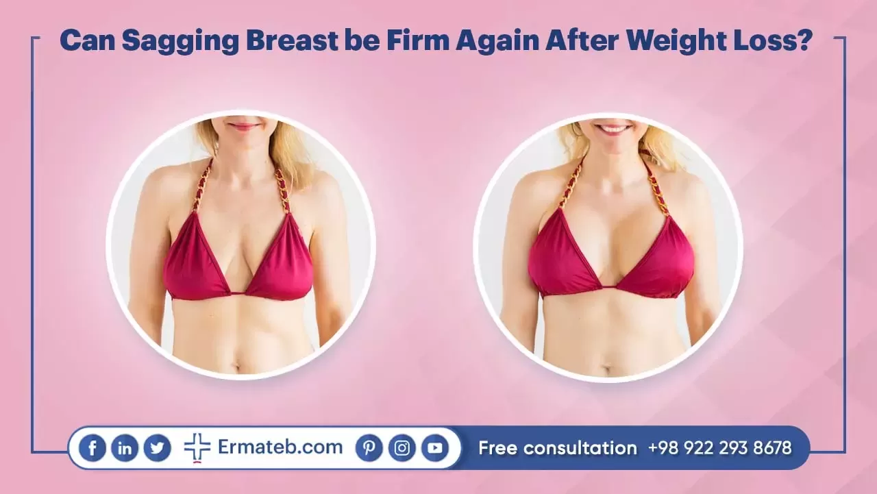 Can Sagging Breast be Firm Again After Weight Loss?