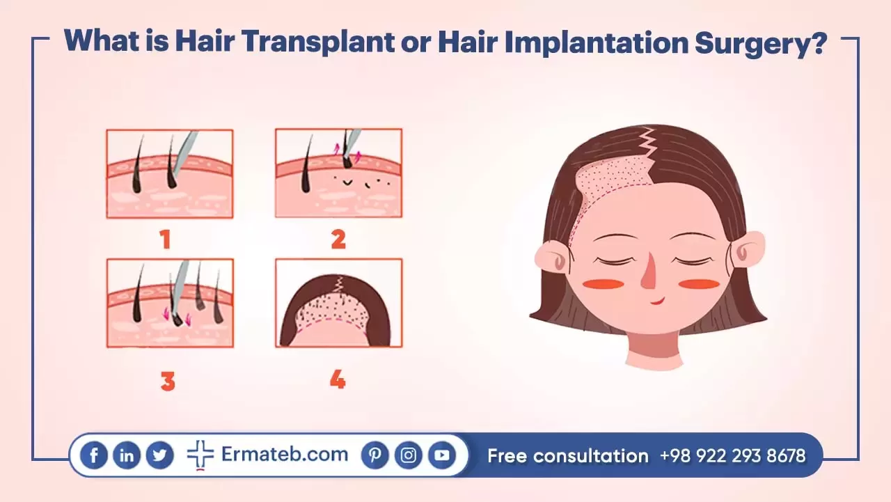 What is Hair Transplant or Hair Implantation Surgery?