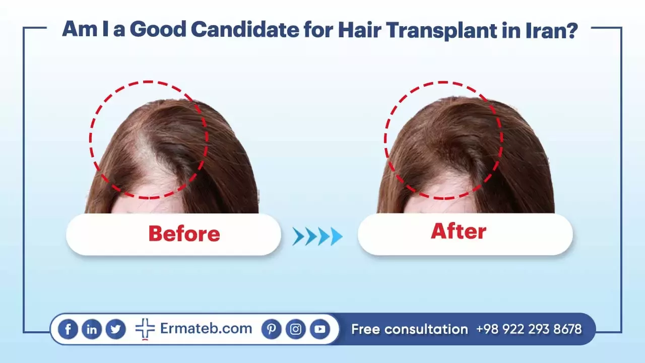 Am I a Good Candidate for Hair Transplant in Iran?