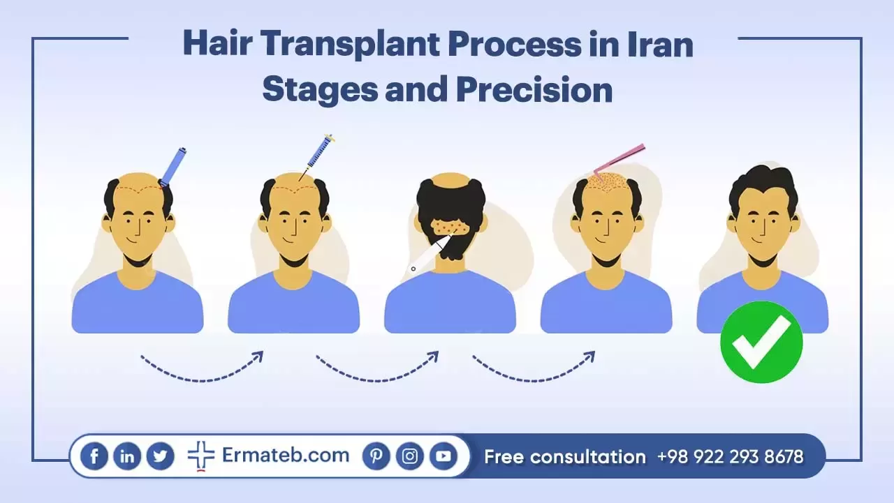 Hair Transplant Process in Iran: Stages and Precision