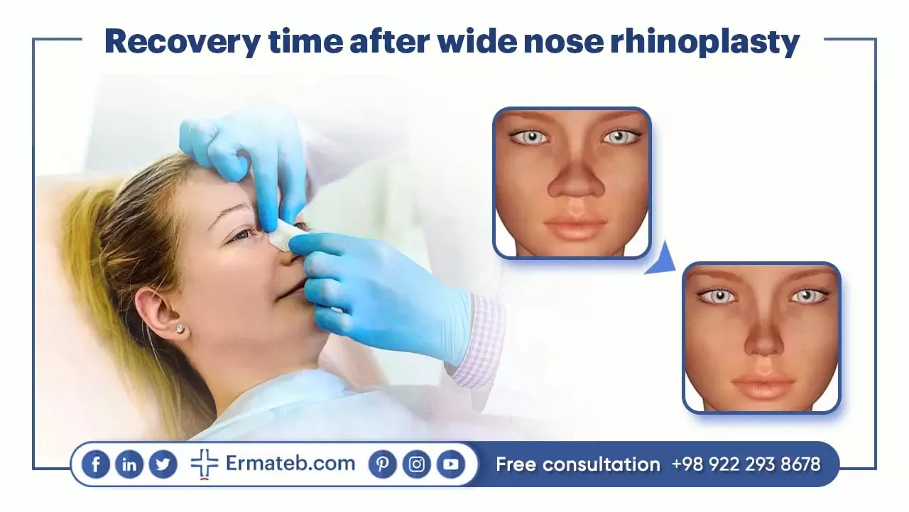 Recovery time after wide nose rhinoplasty