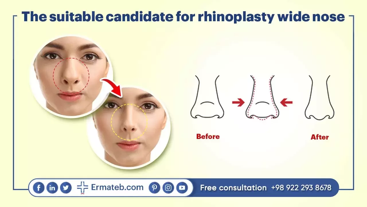 The suitable candidate for rhinoplasty wide nose