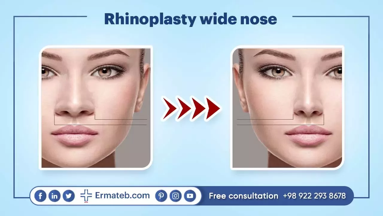 Rhinoplasty wide nose