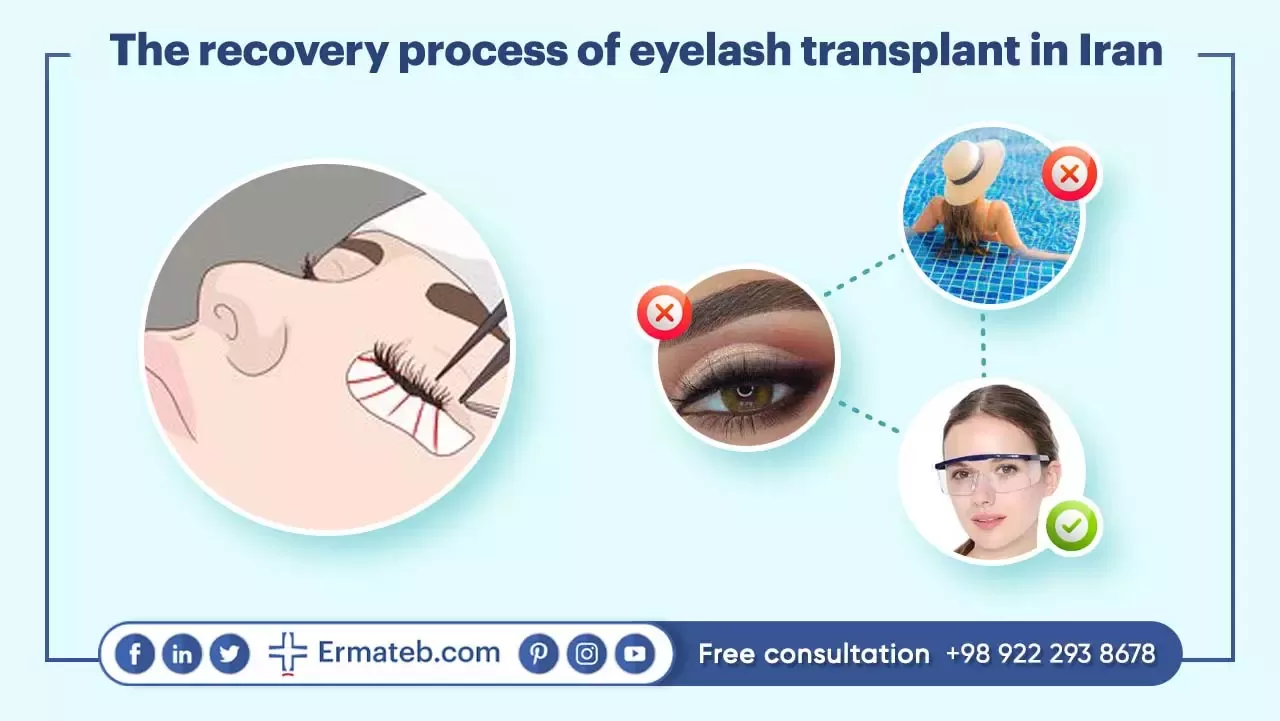 The recovery process of eyelash transplant in Iran
