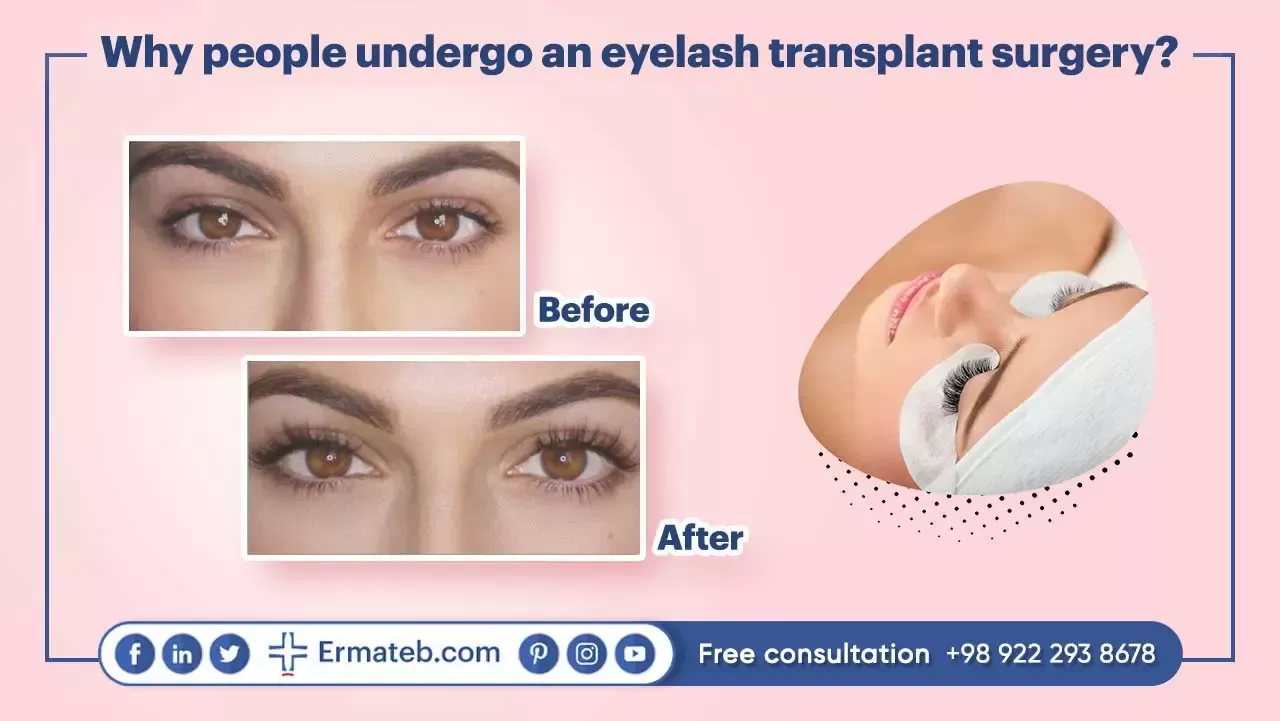 Why people undergo an eyelash transplant surgery?