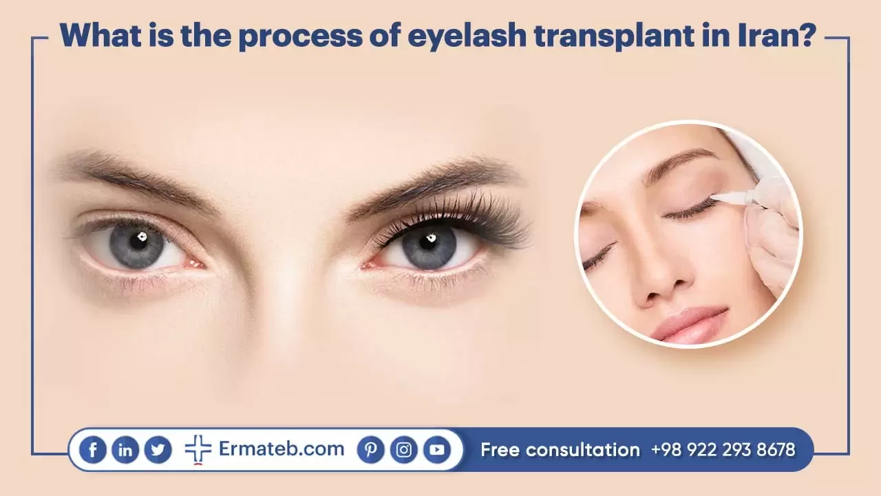 What is the process of eyelash transplant in Iran?