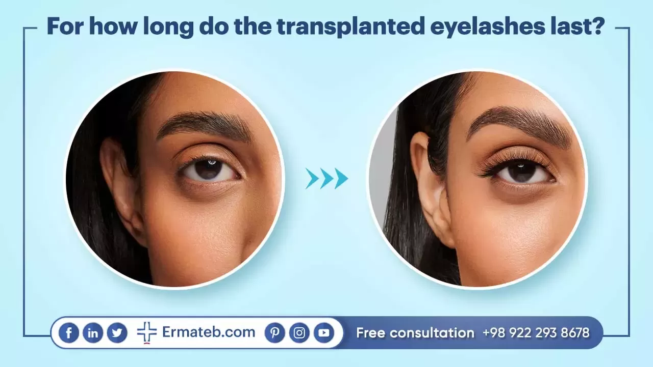For how long do the transplanted eyelashes last?