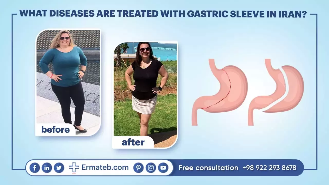 WHAT DISEASES ARE TREATED WITH GASTRIC SLEEVE IN IRAN? 