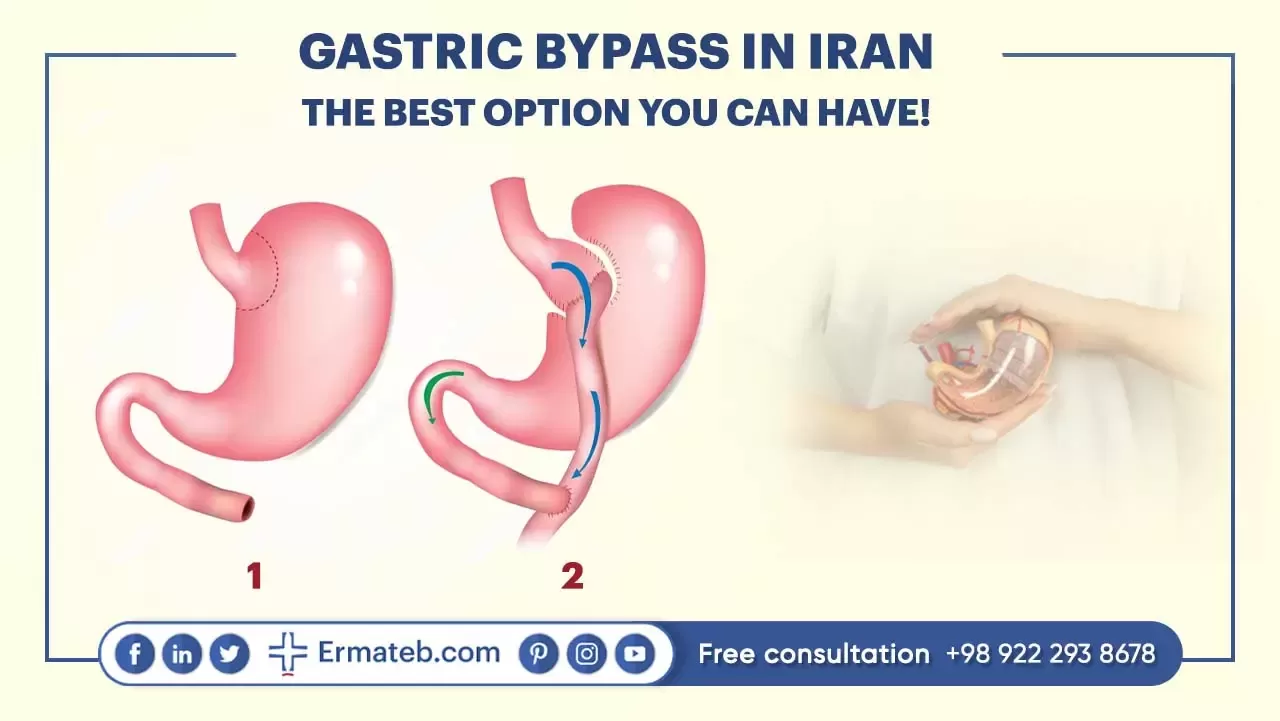GASTRIC BYPASS IN IRAN THE BEST OPTION YOU CAN HAVE!