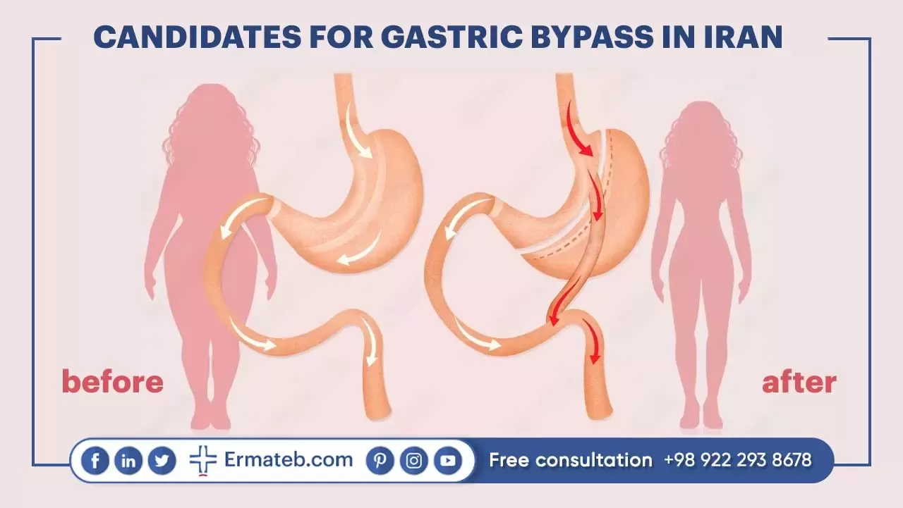CANDIDATES FOR GASTRIC BYPASS IN IRAN 