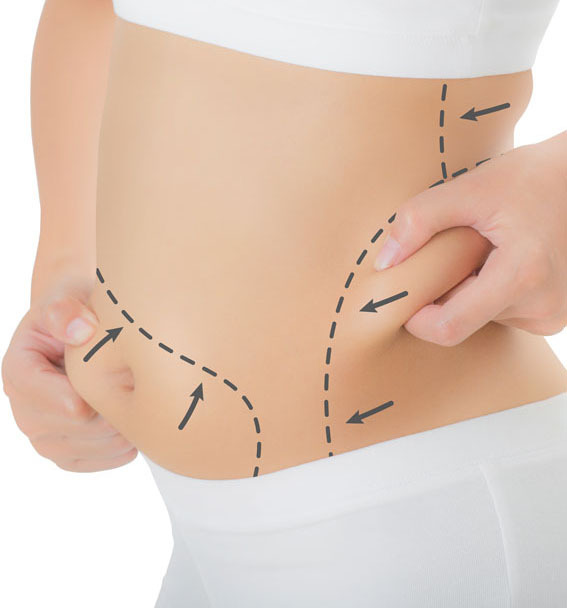 Dos and Don'ts after Tummy Tuck surgery