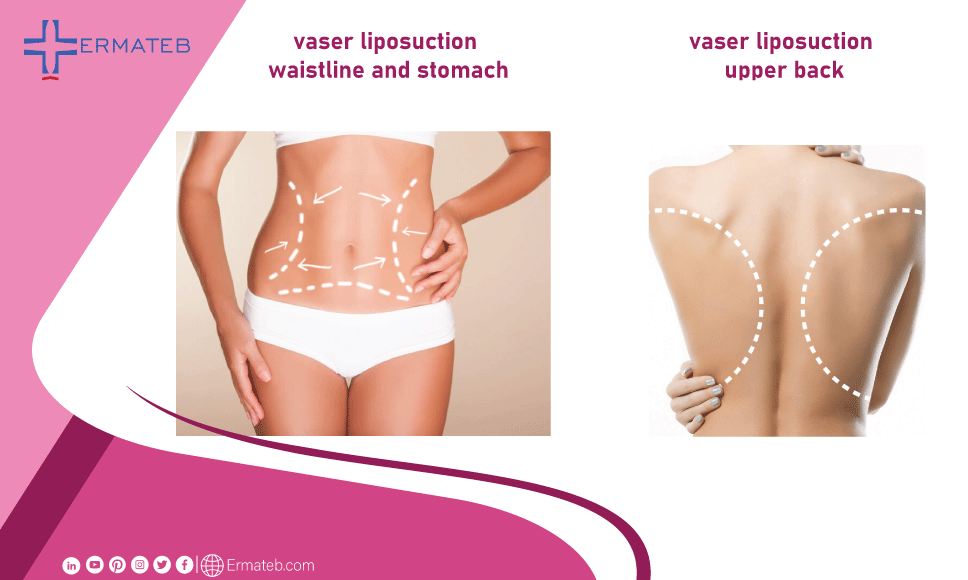 VASER Liposuction: Procedure, Cost, and What to Expect