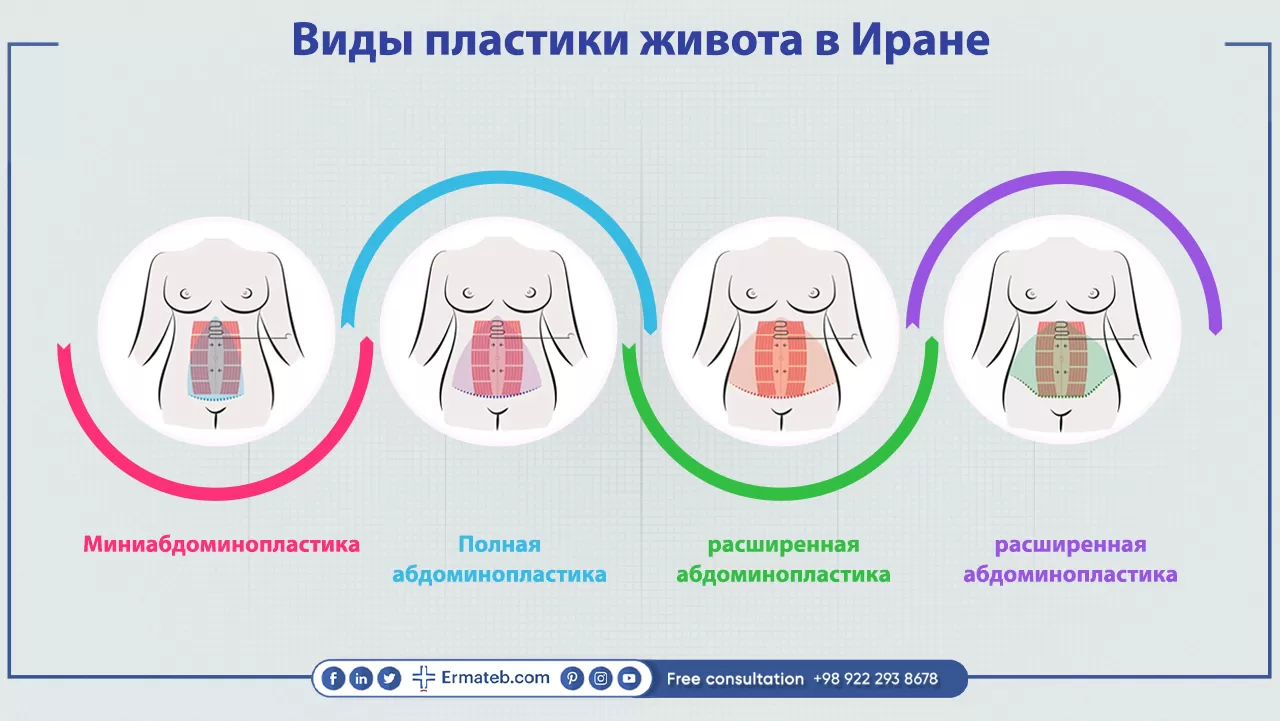 Виды пластики живота в Иране