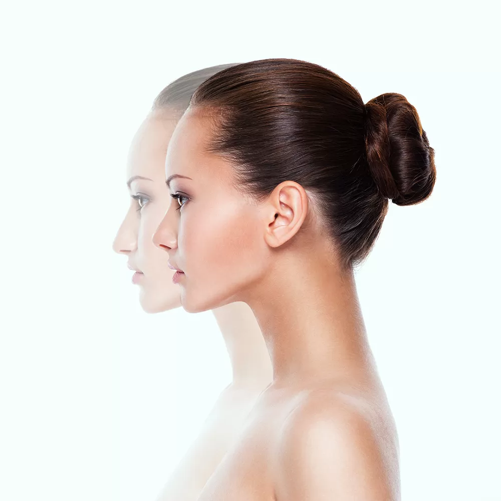 Revision Rhinoplasty In Iran