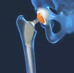  Hip Replacement In Iran 
