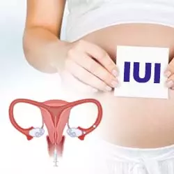 Intrauterine Insemination in Iran