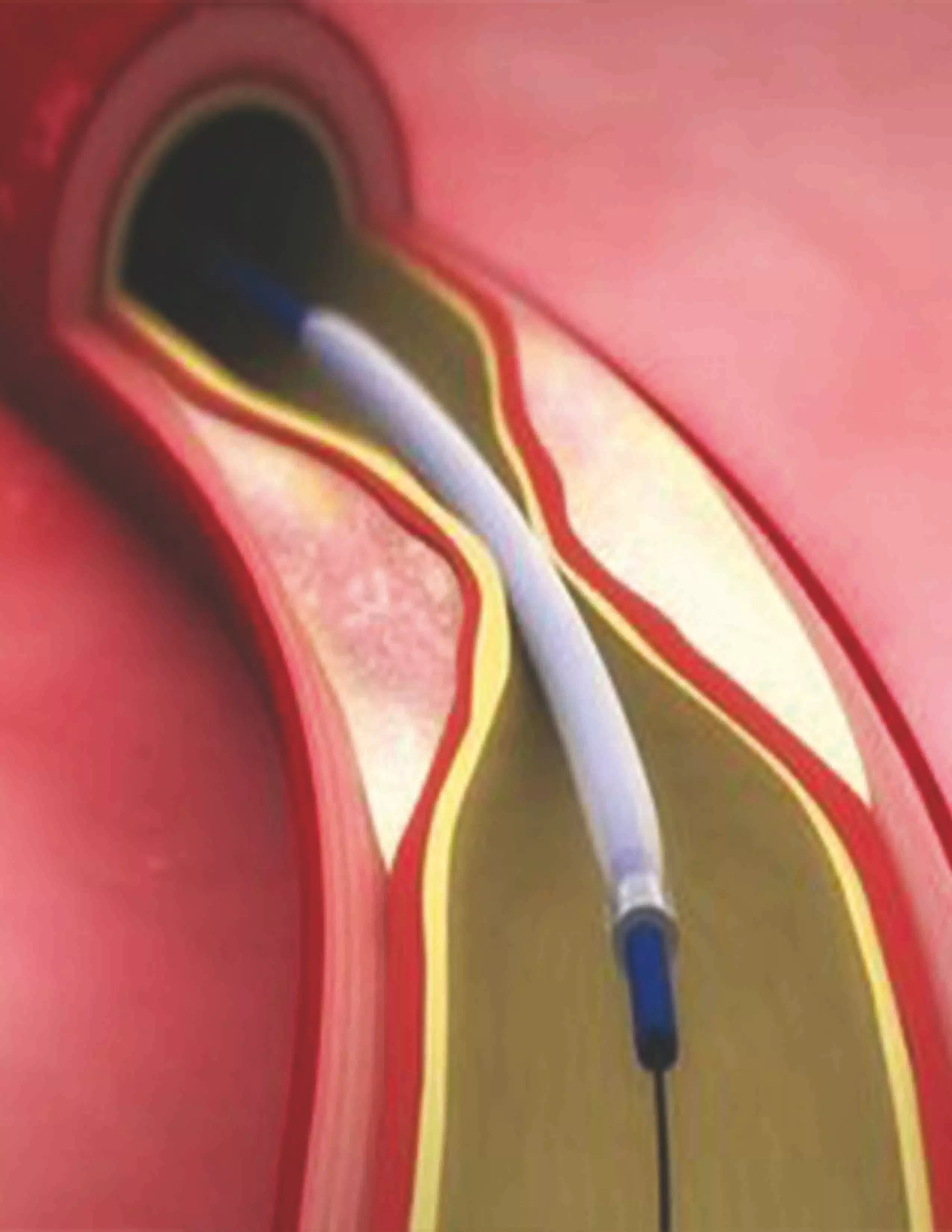 Angiography in Iran