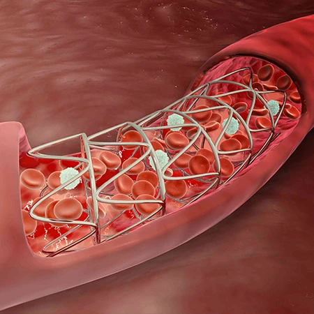 Angioplasty in Iran