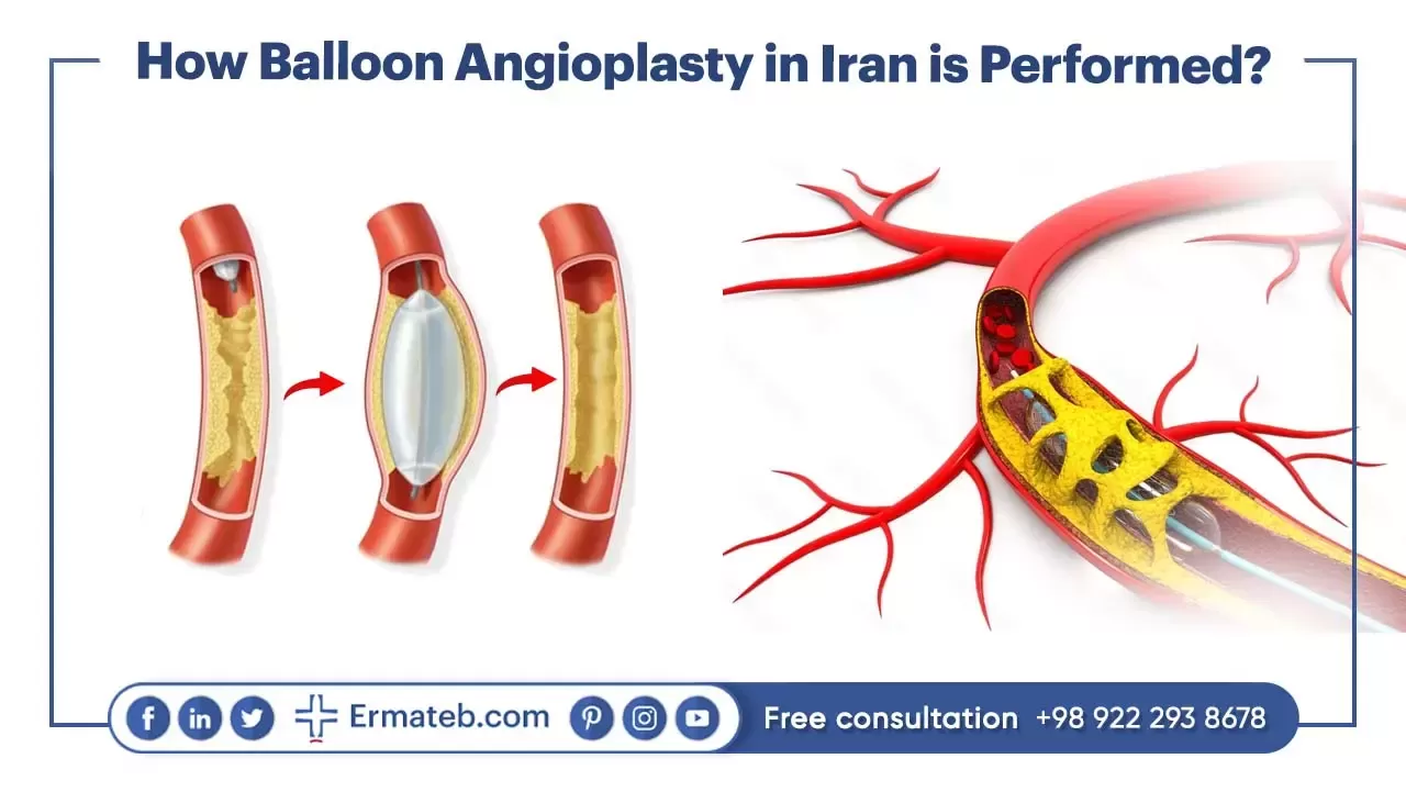 How Balloon Angioplasty in Iran is Performed?