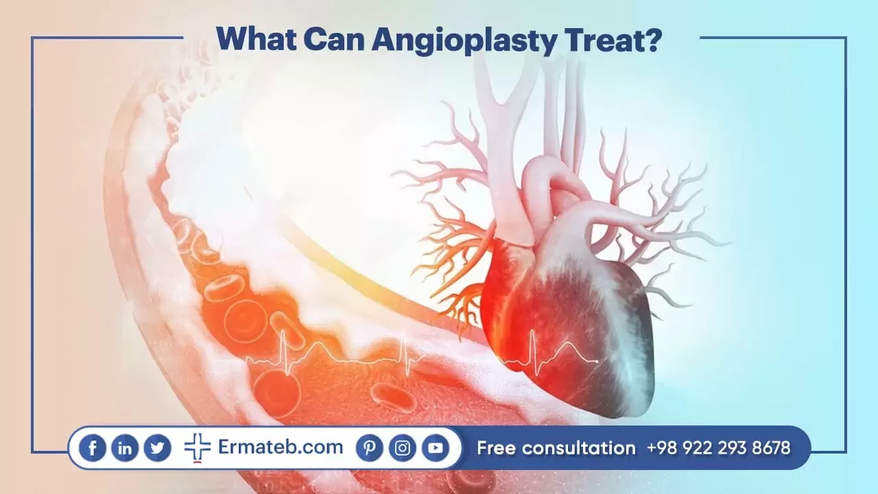 What Can Angioplasty Treat?