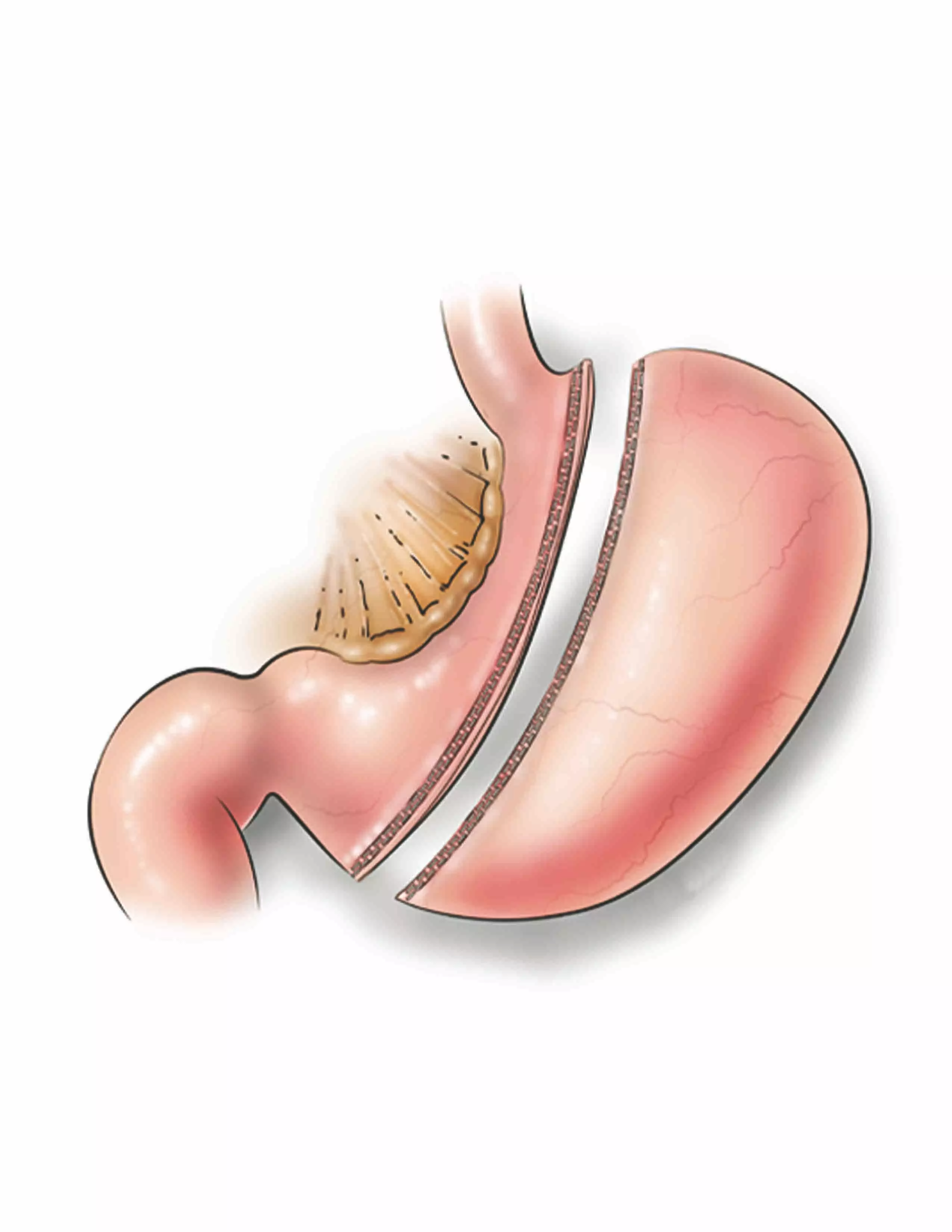 Gastric Sleeve In Iran