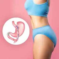 Gastric Bypass In Iran