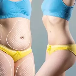 Lap Band procedure in iran