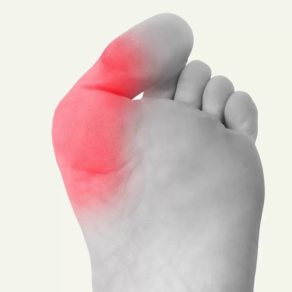 Bunion Surgery in Iran