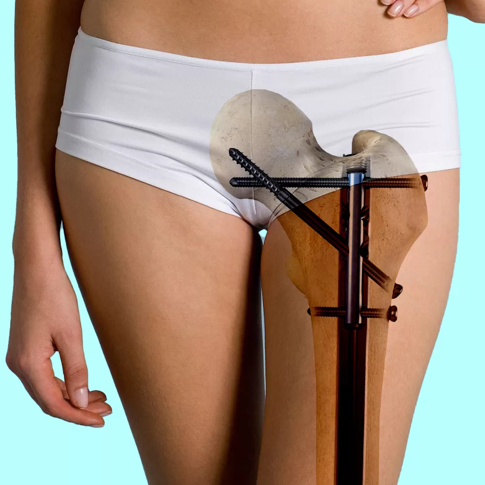 Hip Nailing Surgery in Iran