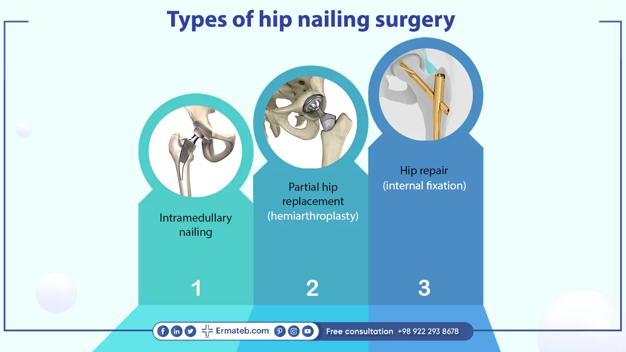 Types of hip nailing surgery 