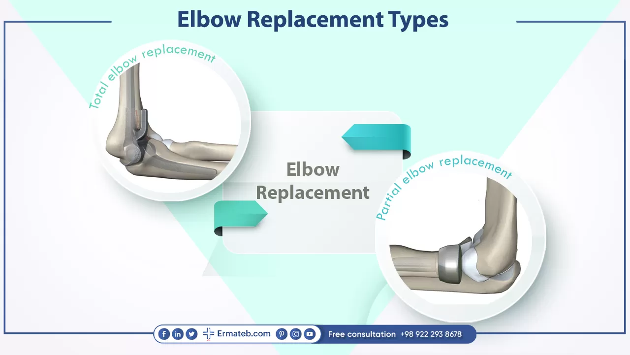 Elbow replacement types 