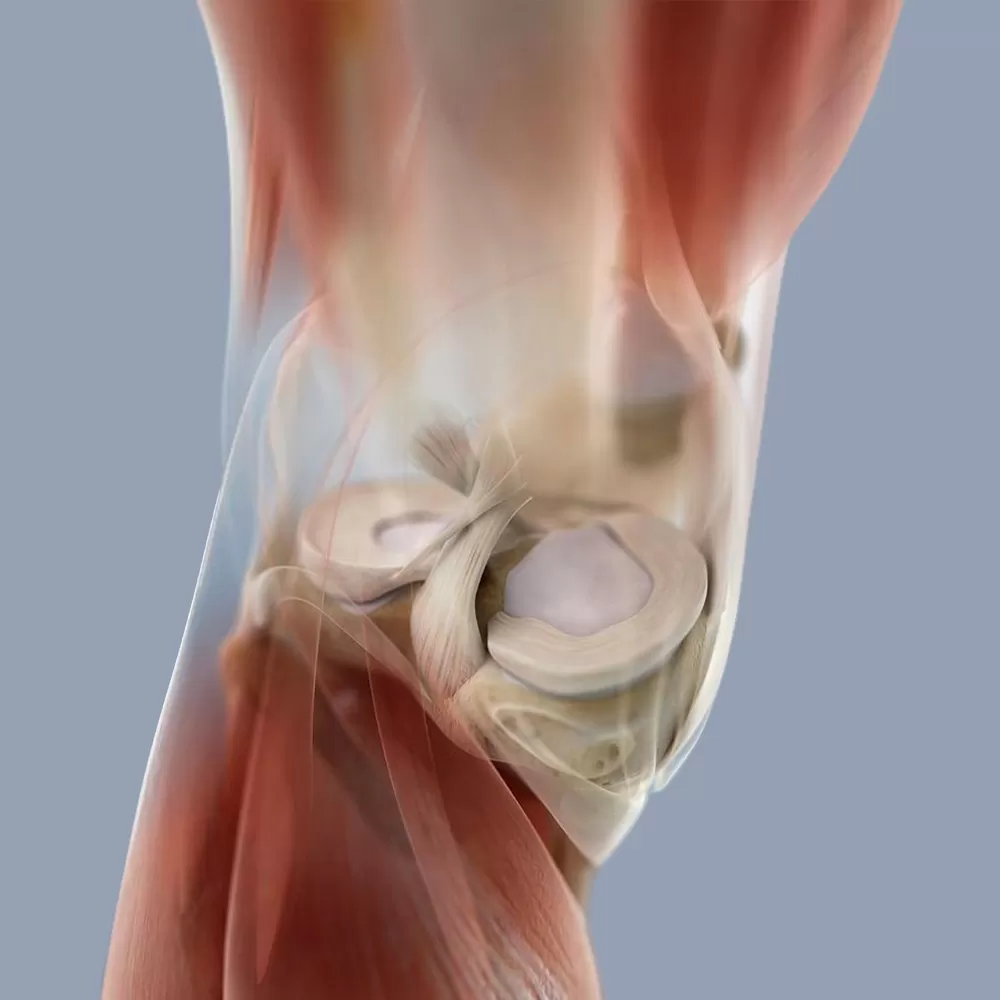 Meniscectomy Surgery in Iran