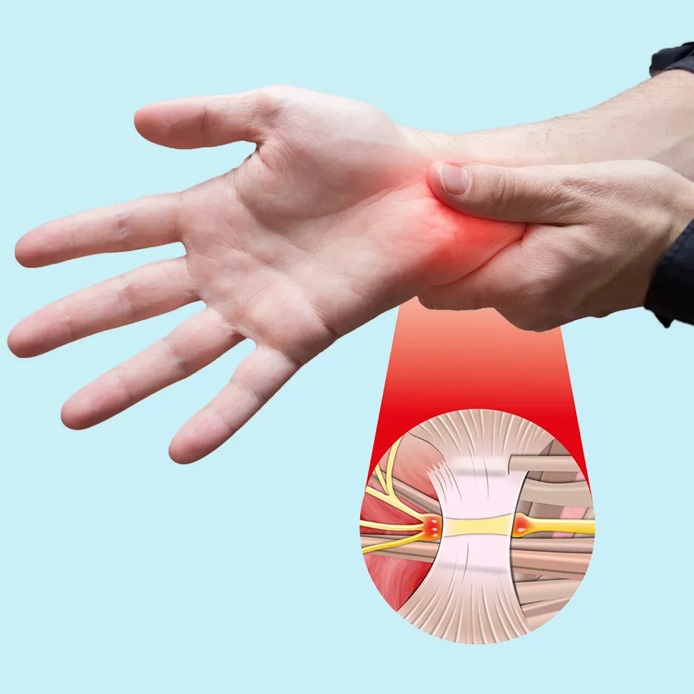 Carpal Tunnel Surgery in Iran