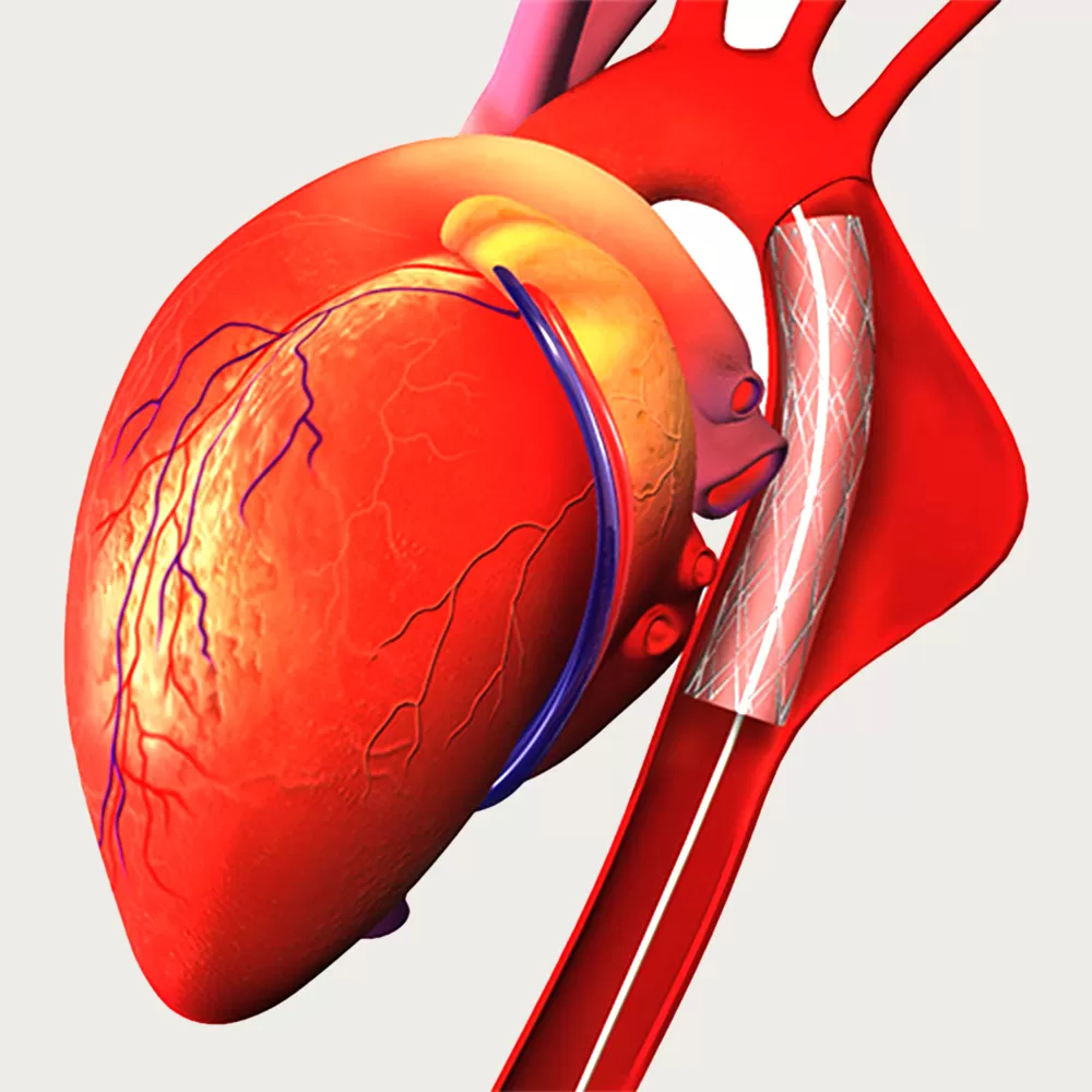Aortic Aneurysm Surgery in Iran