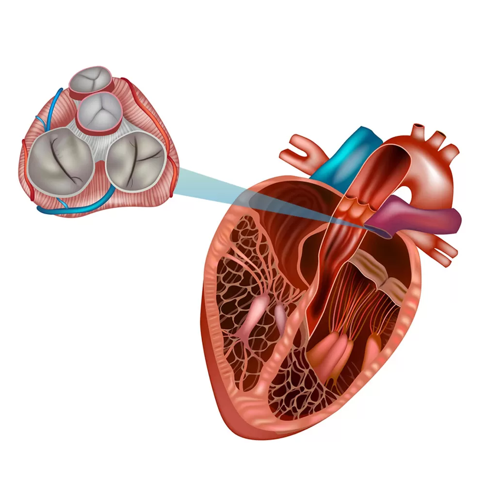 Heart Valve Surgery in Iran