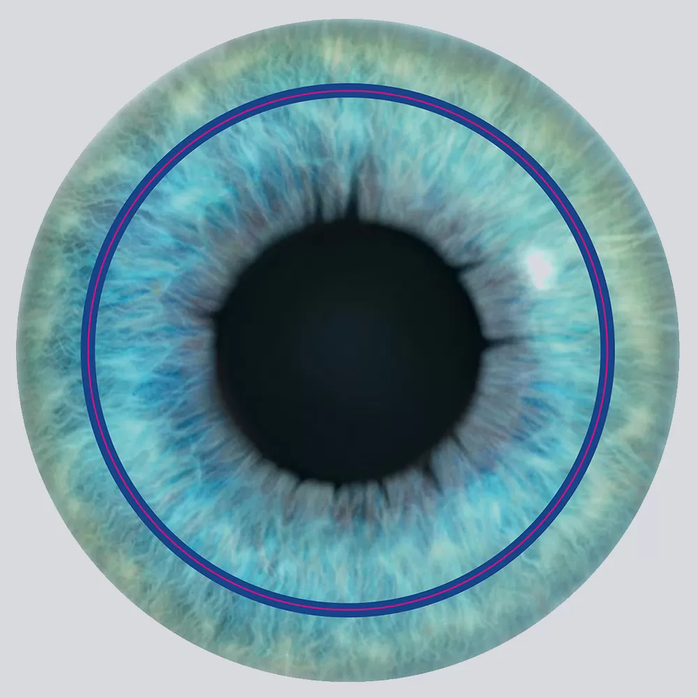 Femto Lasik Surgery in Iran 